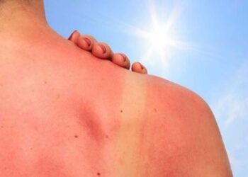COFCR: ¿Cuál es la mejor protección para que el sol no queme nuestra piel?