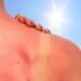 COFCR: ¿Cuál es la mejor protección para que el sol no queme nuestra piel?