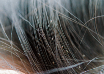 COFCR: recomendaciones para prevenir los piojos